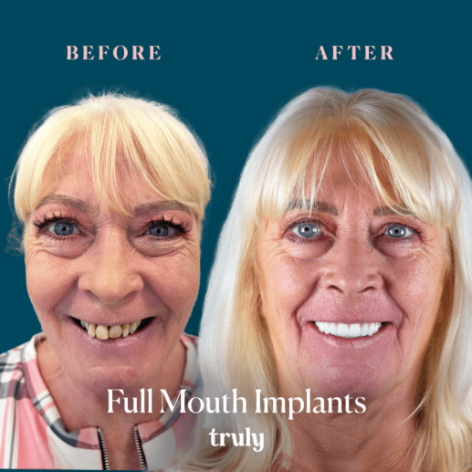 Implants