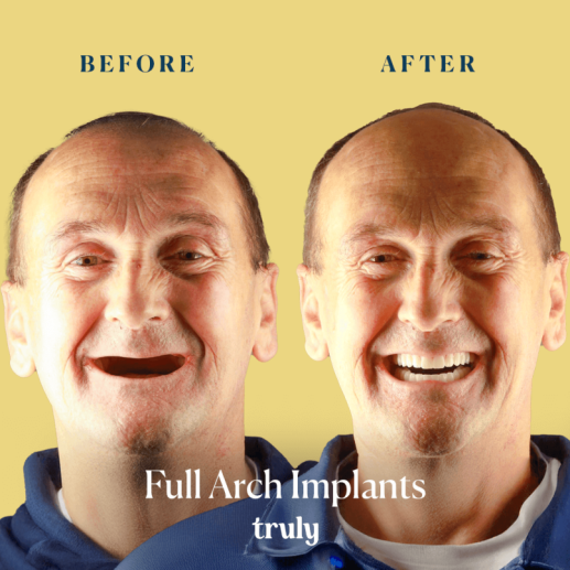 Implants