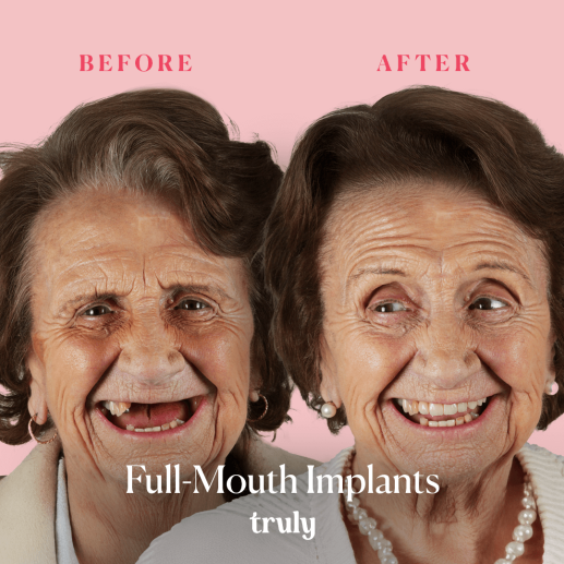 Implants