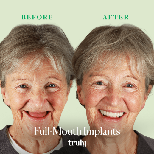 Implants
