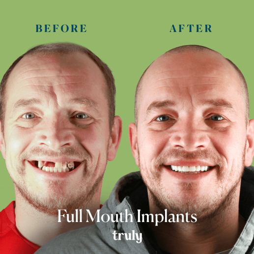 Implants