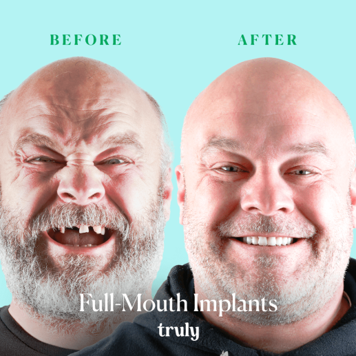 Implants