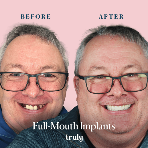 Implants