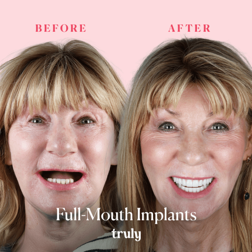 Implants