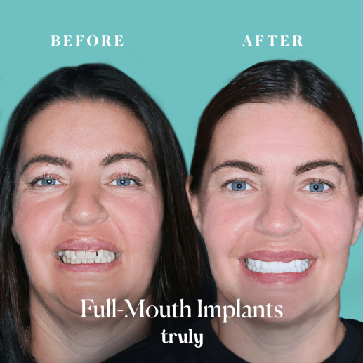 Implants