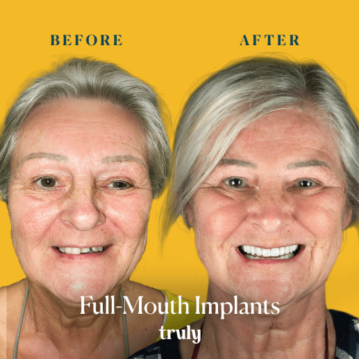 Implants