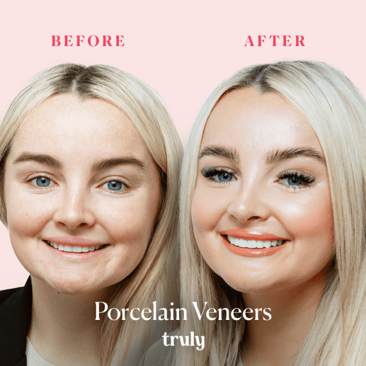 Veneers