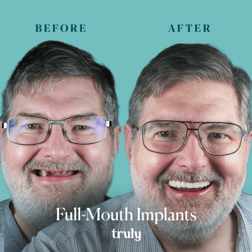 Implants