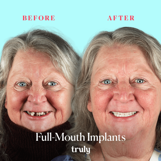 Implants