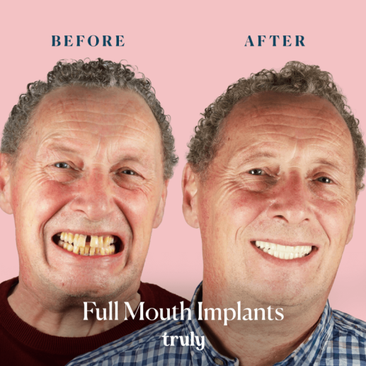 Implants