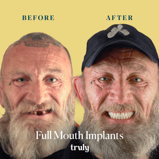 Implants