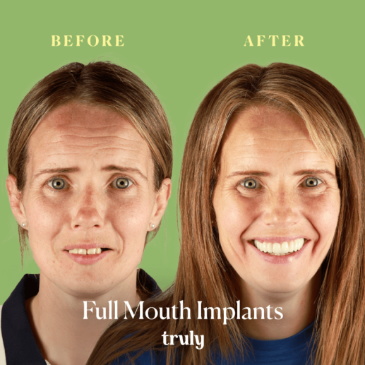 Implants