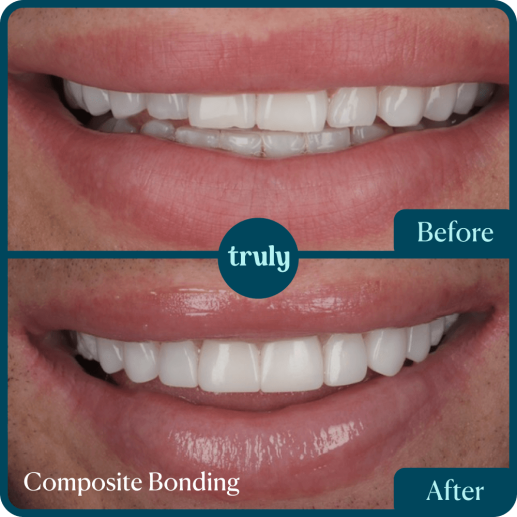 Composite bonding