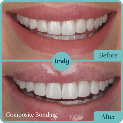 Composite bonding