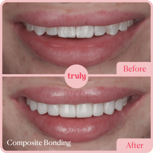 Composite bonding