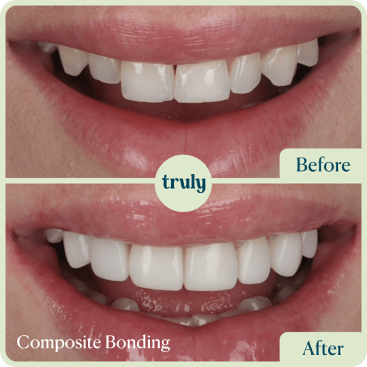 Composite bonding