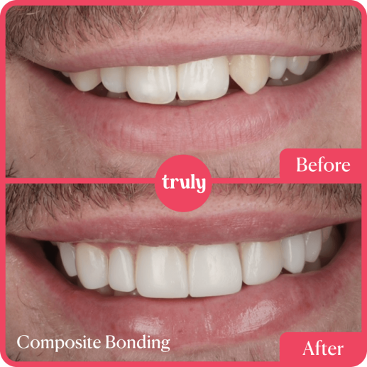 Composite bonding
