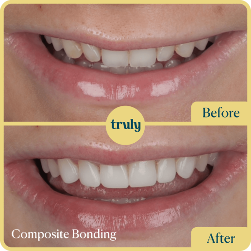 Composite bonding