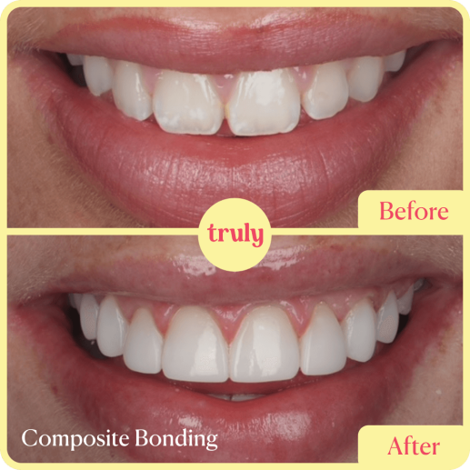 Composite bonding