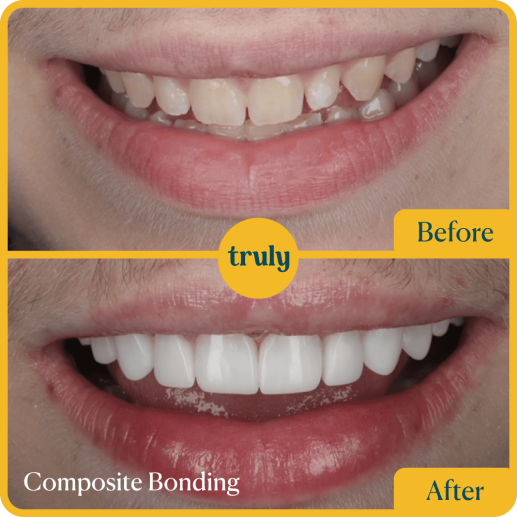 Composite bonding