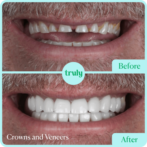 Crowns and Veneers
