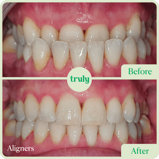 Aligners