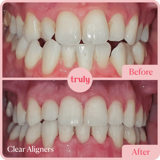 Clear Aligners