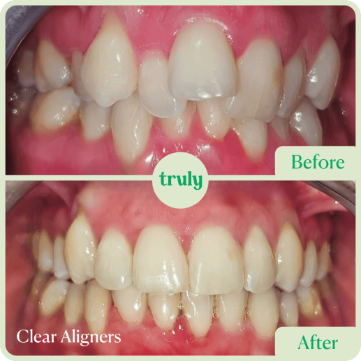 Clear Aligners