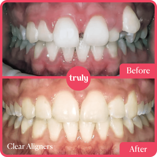 Clear Aligners