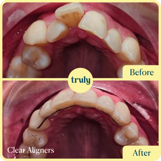 Clear Aligners