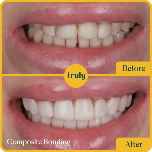 Composite bonding