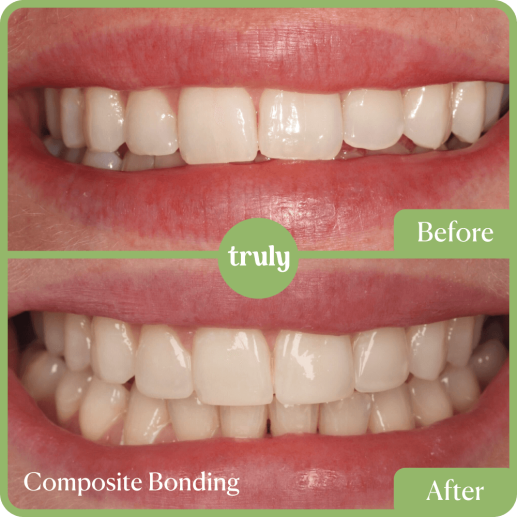 Composite bonding