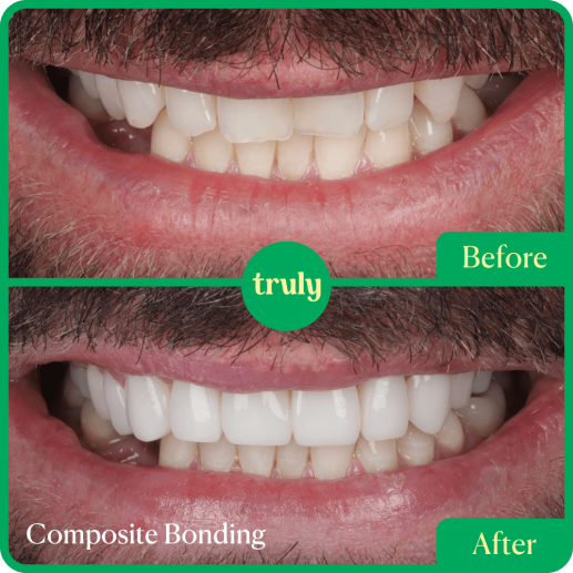Composite bonding