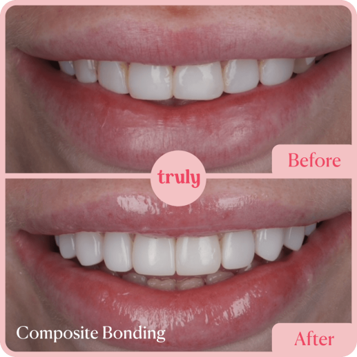 Composite bonding
