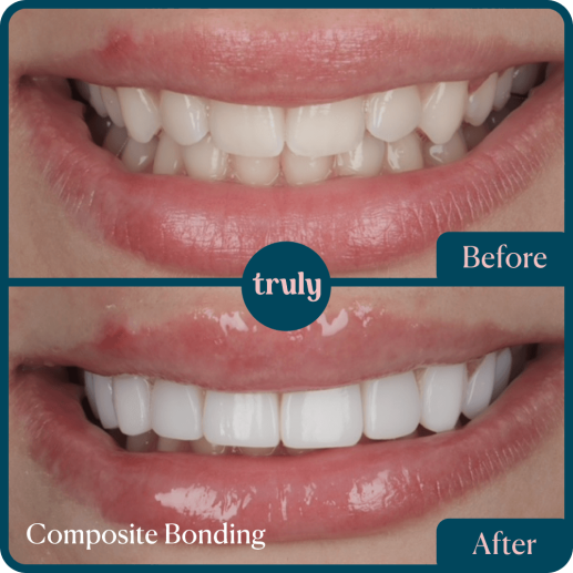 Composite bonding