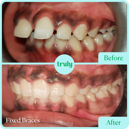 Fixed Braces