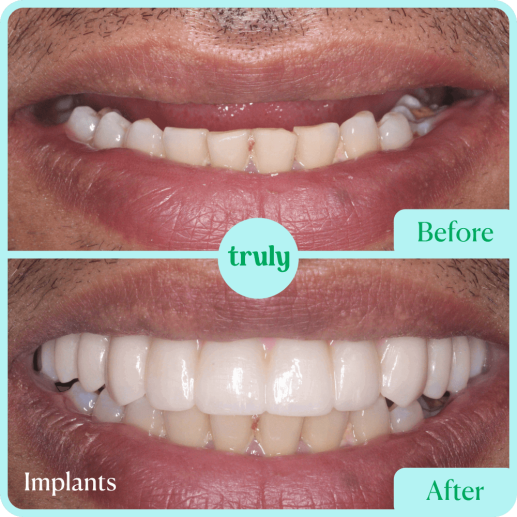 Implants
