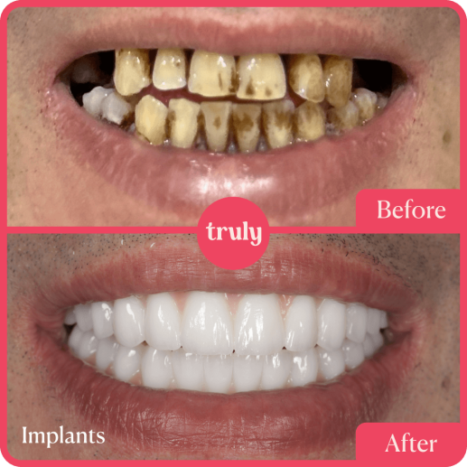 Implants