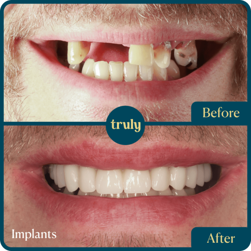 Implants
