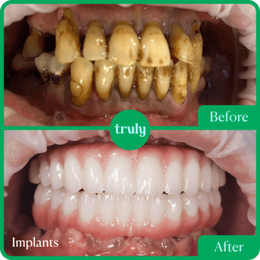 Implants