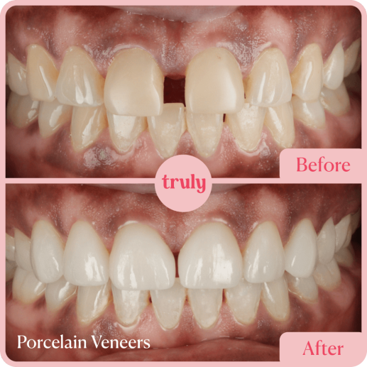 Porcelain Veneers