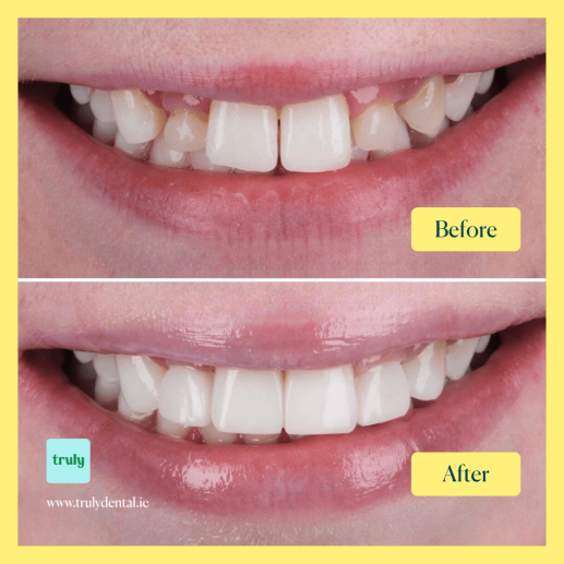 Composite bonding