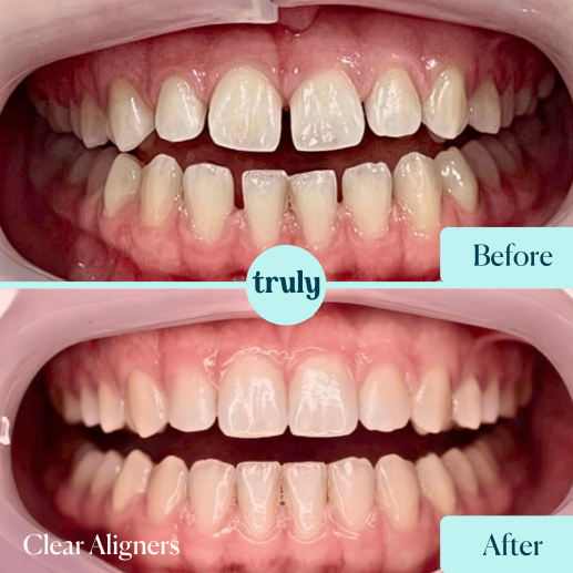 Clear Aligners