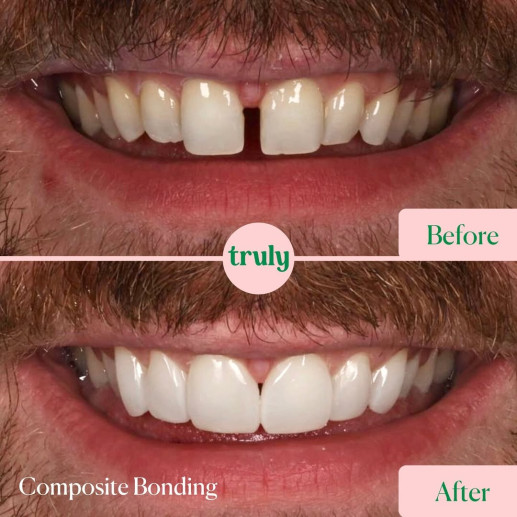 Composite bonding
