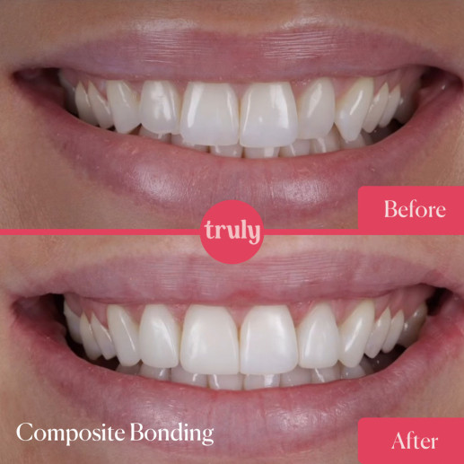 Composite bonding