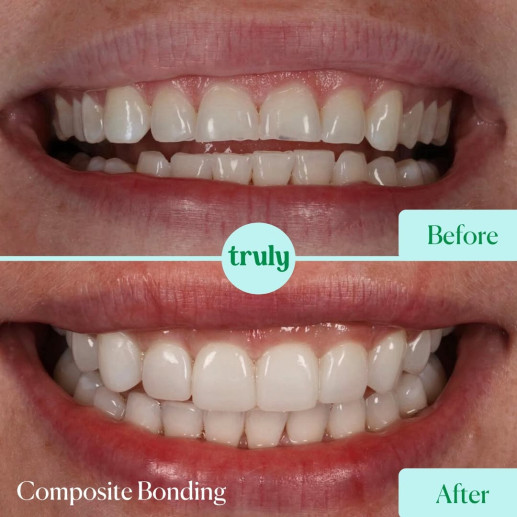 Composite bonding