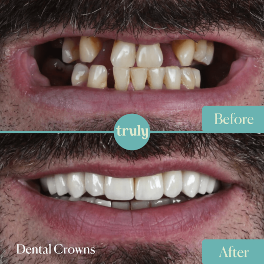 Dental crowns