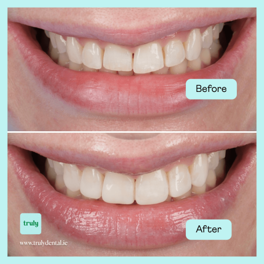Composite bonding