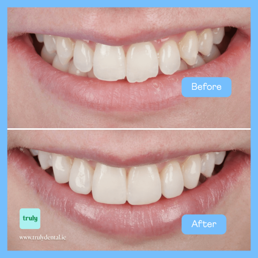 Composite bonding