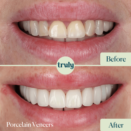 Porcelain Veneers